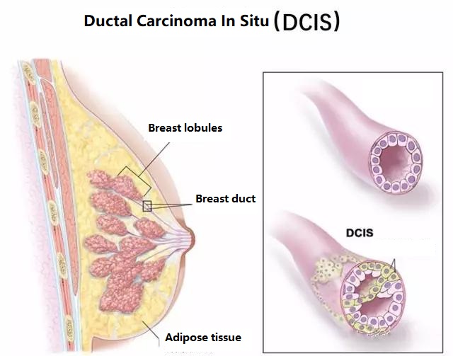 Breast Cancer: Ductal Carcinoma In Situ (DCIS)
