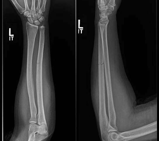 1/3 American women with ulna fractures may have suffered domestic violence
