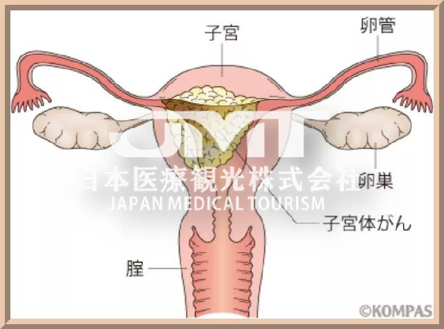 JMT: Beware of irregular menstruation and beware of endometrial cancer