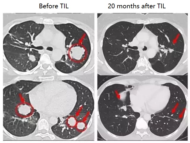 TILs cellular immunotherapy: 1st patient already ten years!