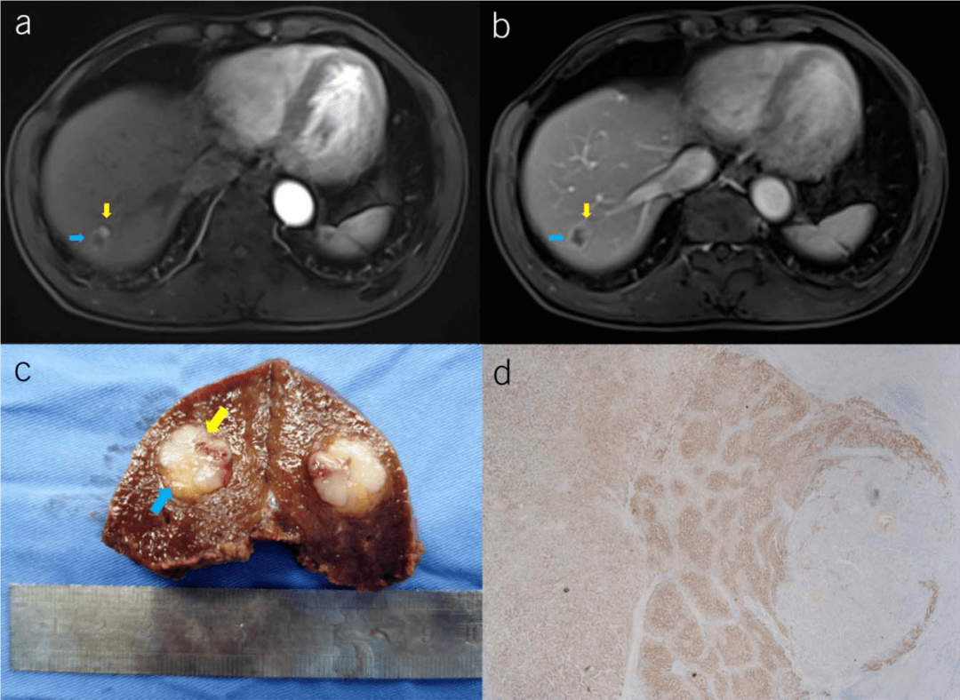 AJG special case: mixed cell liver cancer with clear boundaries