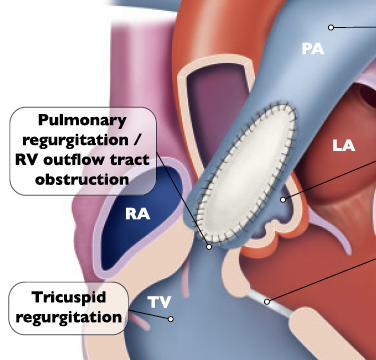 Innovation and progress of transcatheter pulmonary valve replacement