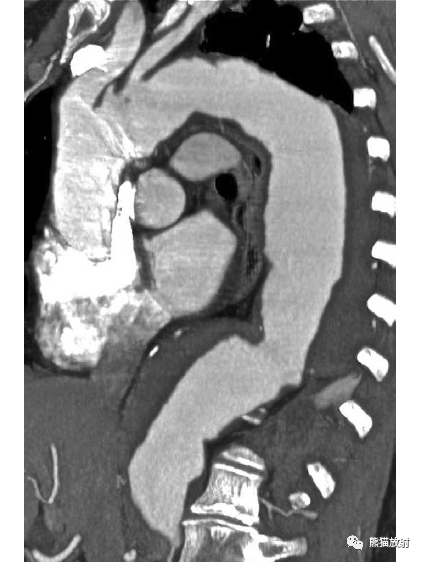 Aortic aneurysm: Classification | Imaging Appearance | CT Evaluation Point