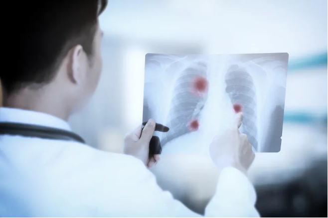 Are lung nodules prone to cancer?