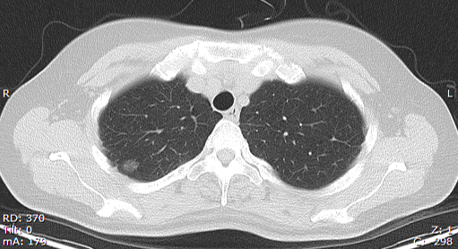 Lung nodules are equivalent to lung cancer？