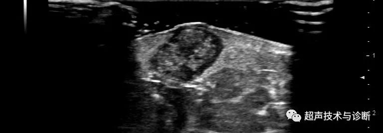 Ultrasonic diagnosis of calcified epithelioma