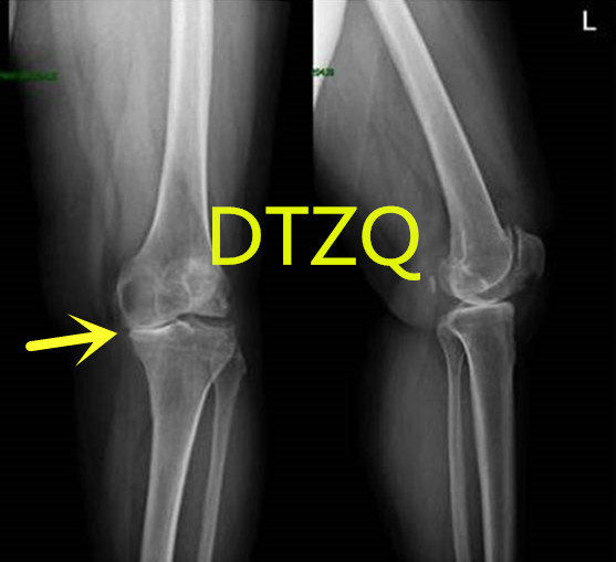 Questions about high tibial osteotomy (HTO)