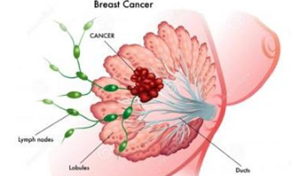 Breast cancer IDC type: mucinous breast carcinoma
