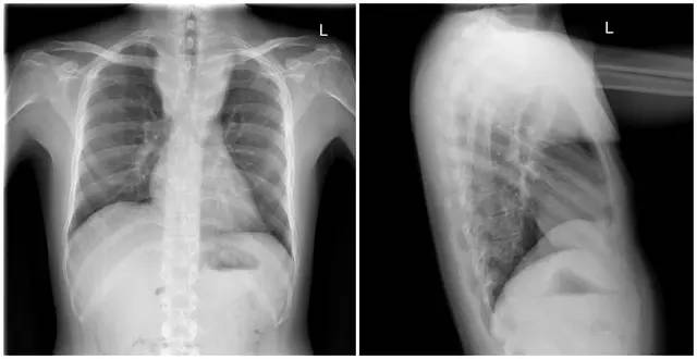 Spinal tuberculosis: Pay attention to distinguish it from spondylitis!