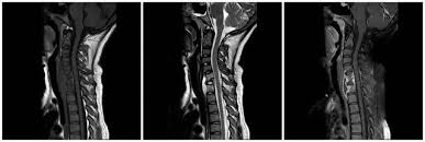 When does spinal tuberculosis need surgery?
