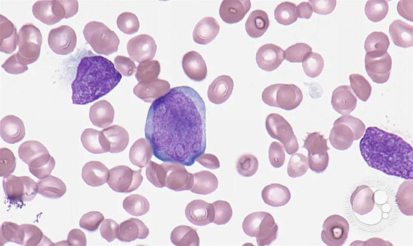 Crizotinib was approved to treat anaplastic large cell lymphoma