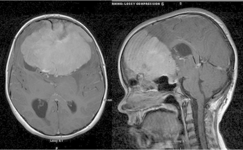 Treatment of meningiomas of the skull base in children