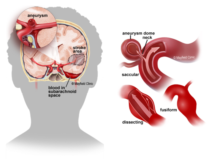How to deal with cerebral aneurysm rupture?