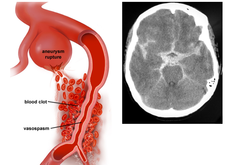How to deal with cerebral aneurysm rupture?