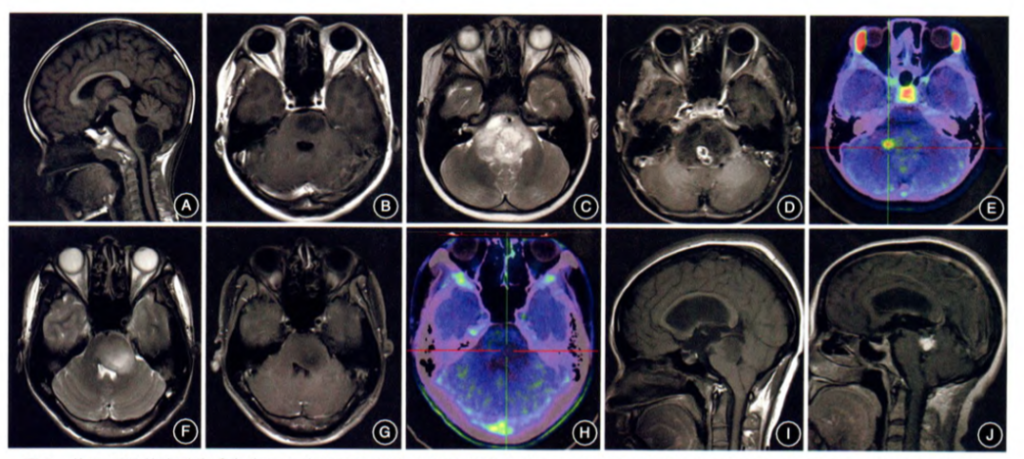 Which brainstem glioma patients can undergo surgery?