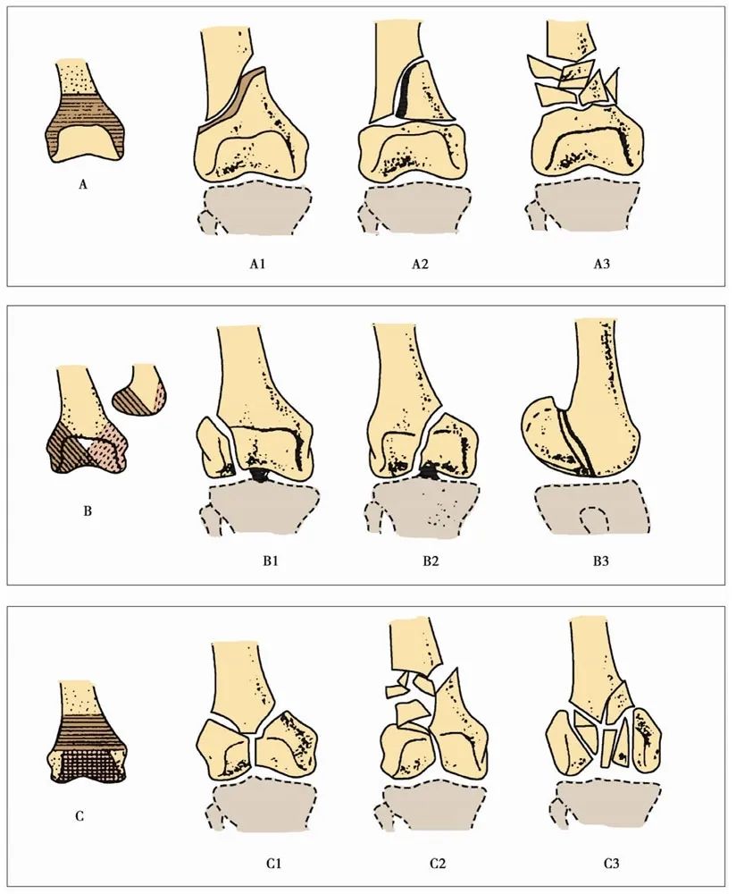 The AO classification of distal femoral fractures