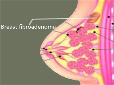 Breast fibroadenoma is breast cancer?