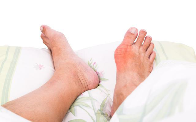What are the main symptoms of gout?
