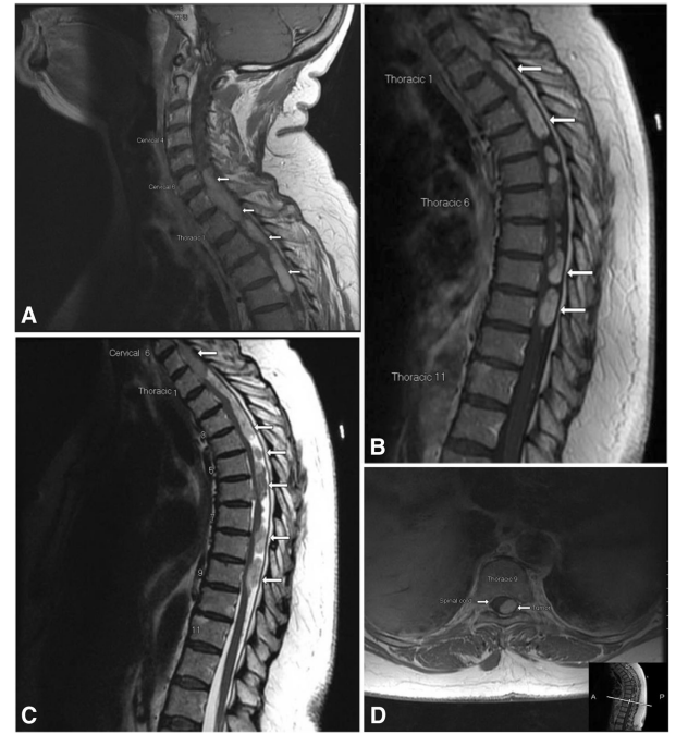 Case Study for primary and multifocal intradural extramedullary hair cell astrocytoma