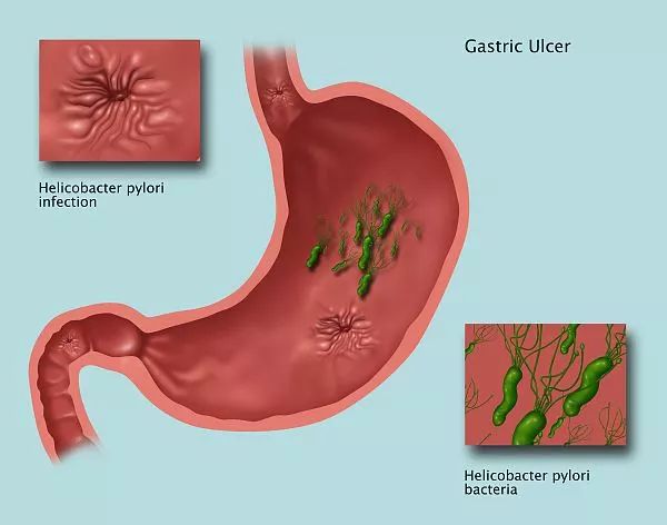 Early symptoms of gastric cancer that may be overlooked