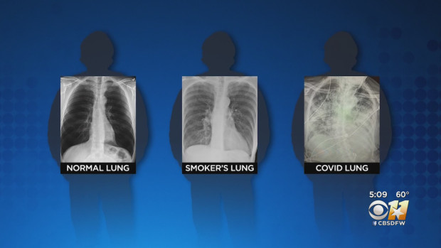 COVID-19 damages the lungs more severely than long-term smoking
