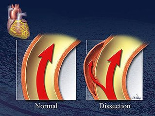 Common problems with aortic dissection