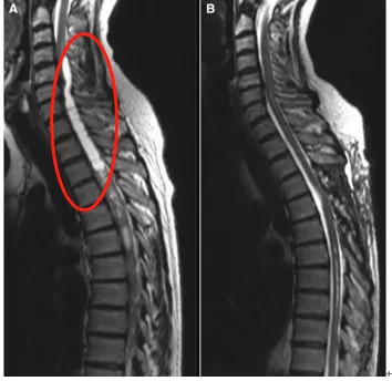 Treatment of ependymal tumors of the spinal cord
