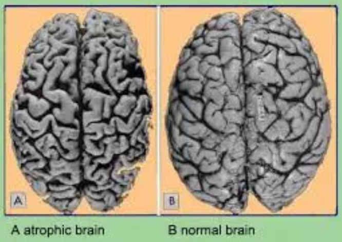 What is brain atrophy and how serious is it?