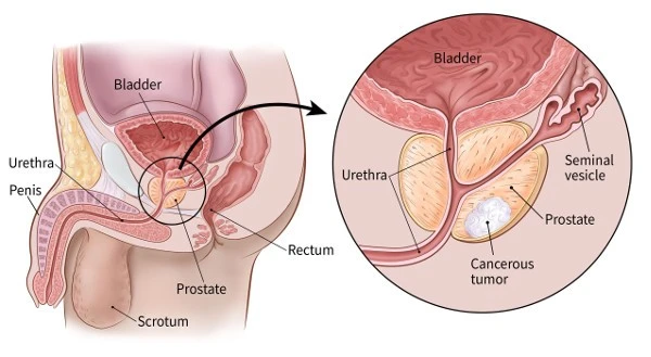 Prostate cancer: Common treatment and related medical devices