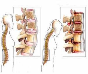What is the cause of ankylosing spondylitis? 