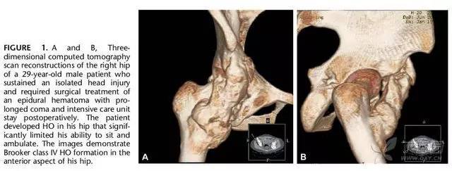 Prevention and treatment of heterotopic ossification