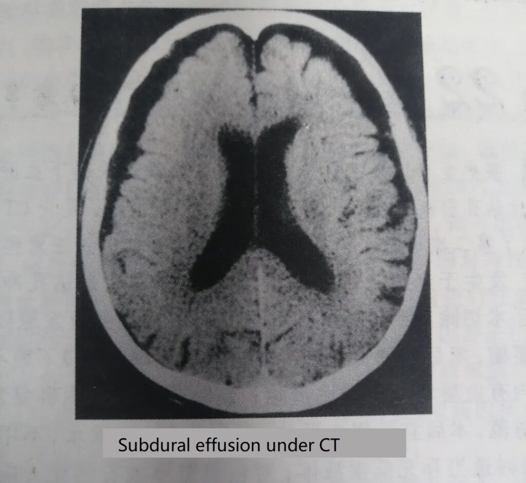 Experts explain what Subdural effusion will cause 