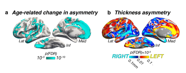 Changes in asymmetry in the cerebral hemispheres increase in Alzheimer