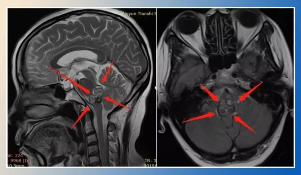 Cavernous hemangioma of the brainstem before surgery