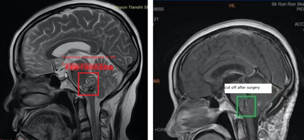 Cavernous hemangioma of the brainstem before surgery