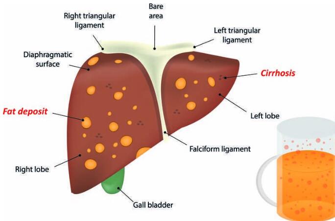 Most people with liver cancer have these 4 characteristics.