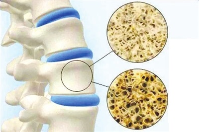 Drugs that cause osteoporosis