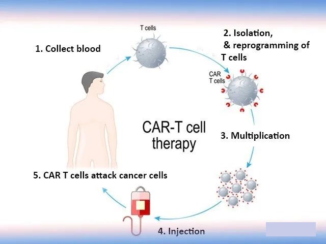 CAR-T cell therapy: 60% of patients are still in remission after 5 years!
