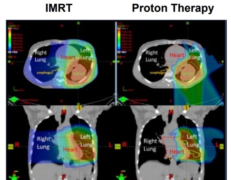 Proton therapy treats canncers/tumors less side effects than Radiation therapy