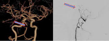 Neurology: Tenecteplase vs  Alteplase in the treatment of basilar artery occlusion