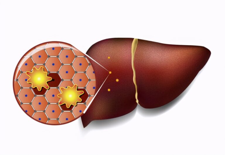 Fatty liver: 3 ways to restore liver function