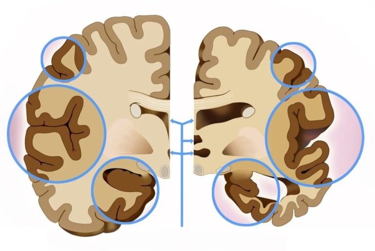 What is the difference between cerebral infarction and brain atrophy?