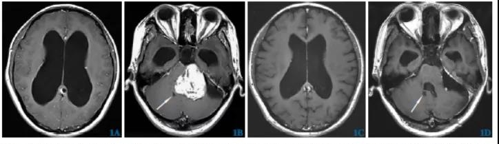 Treatment of Acoustic Neuroma with Hydrocephalus