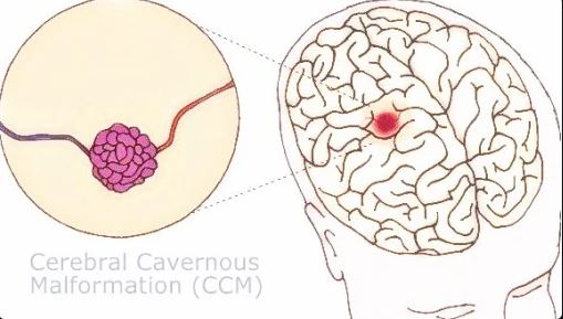 Symptoms and signs of cavernous hemangioma