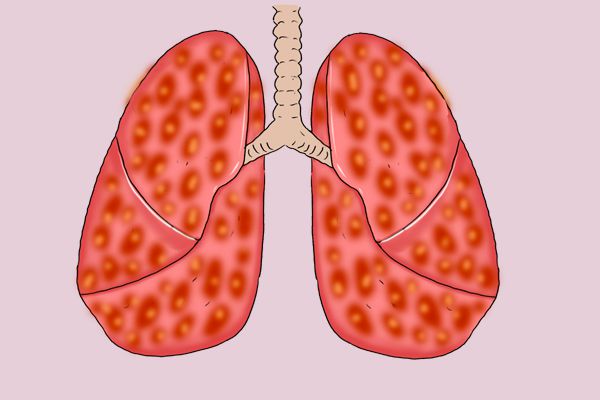 Small cell lung cancer still mainly treated by Chemotherapy and Immunity 