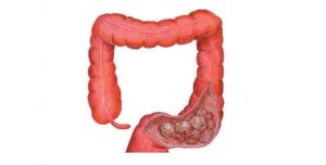What causes colorectal cancer and How to prevent it?