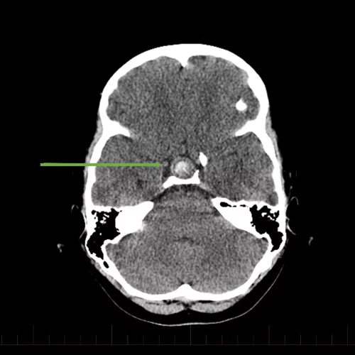 How long can a craniopharyngioma live without surgery?