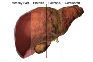 What factors can cause fatty liver to develop into liver cancer?