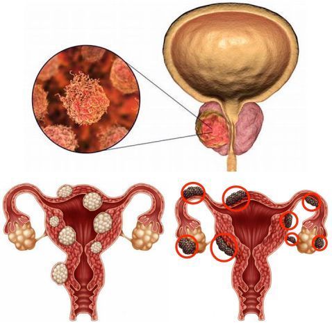FDA approved Myfembree for menorrhagia related to uterine fibroids