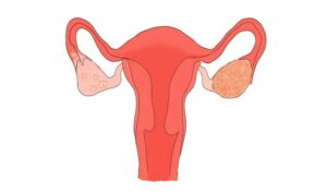 Cellular immunotherapy is effective in treating ovarian cancer!